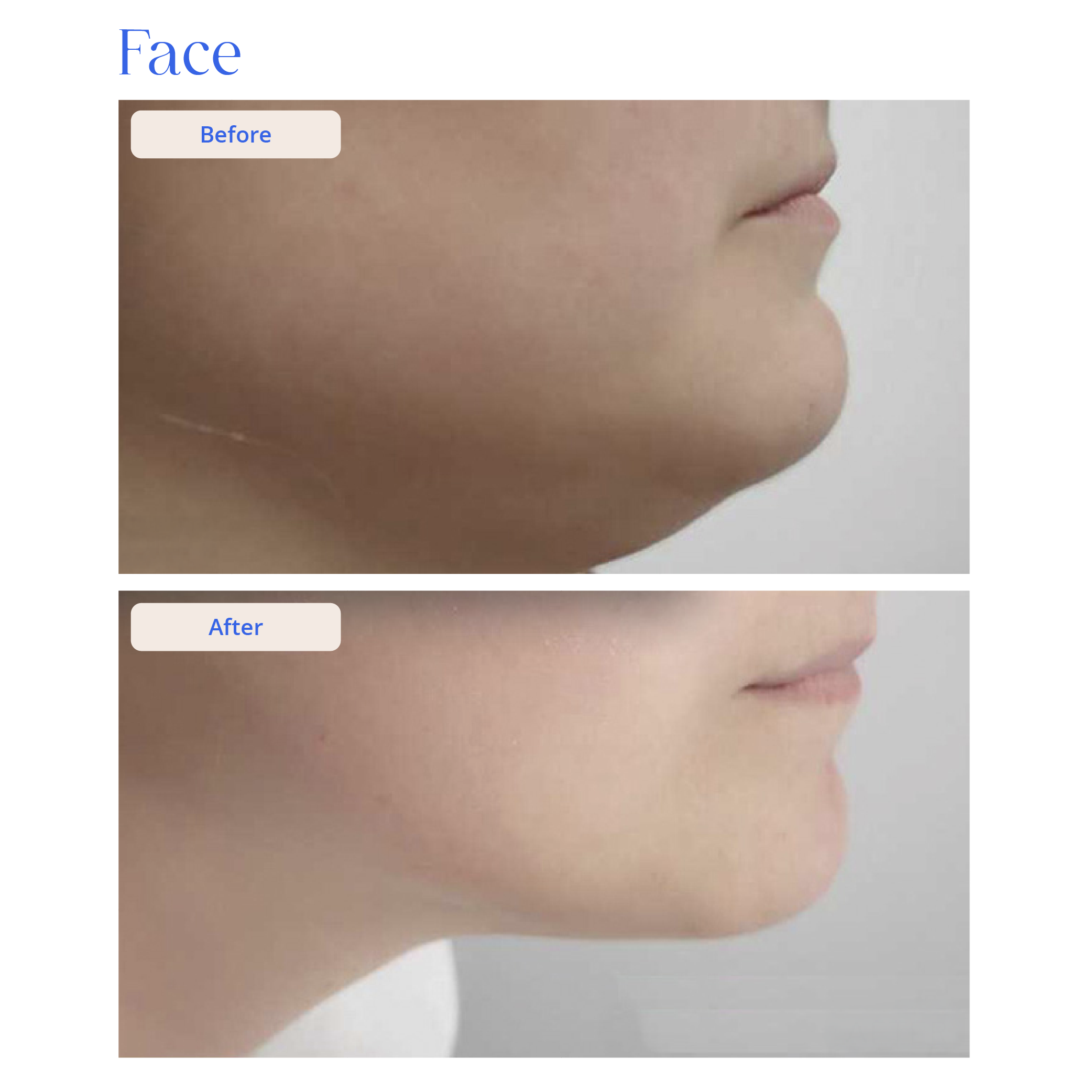 Before and After Result 11