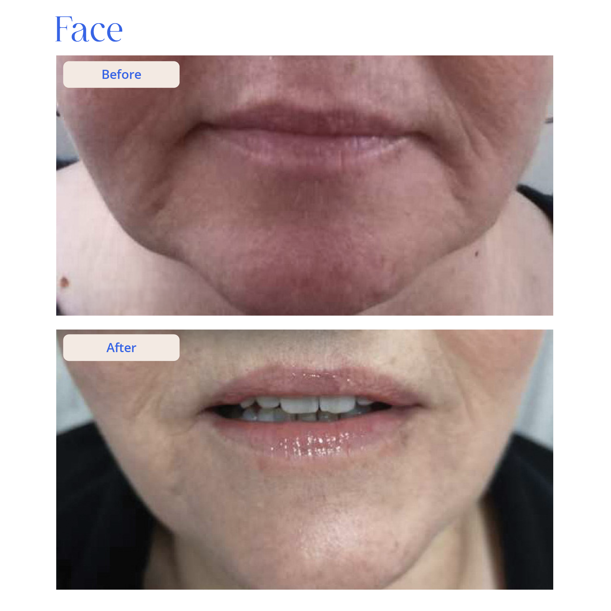 Before and After Result 16